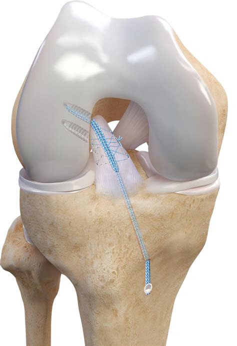 acl surgery greenwich|ACL Reconstruction .